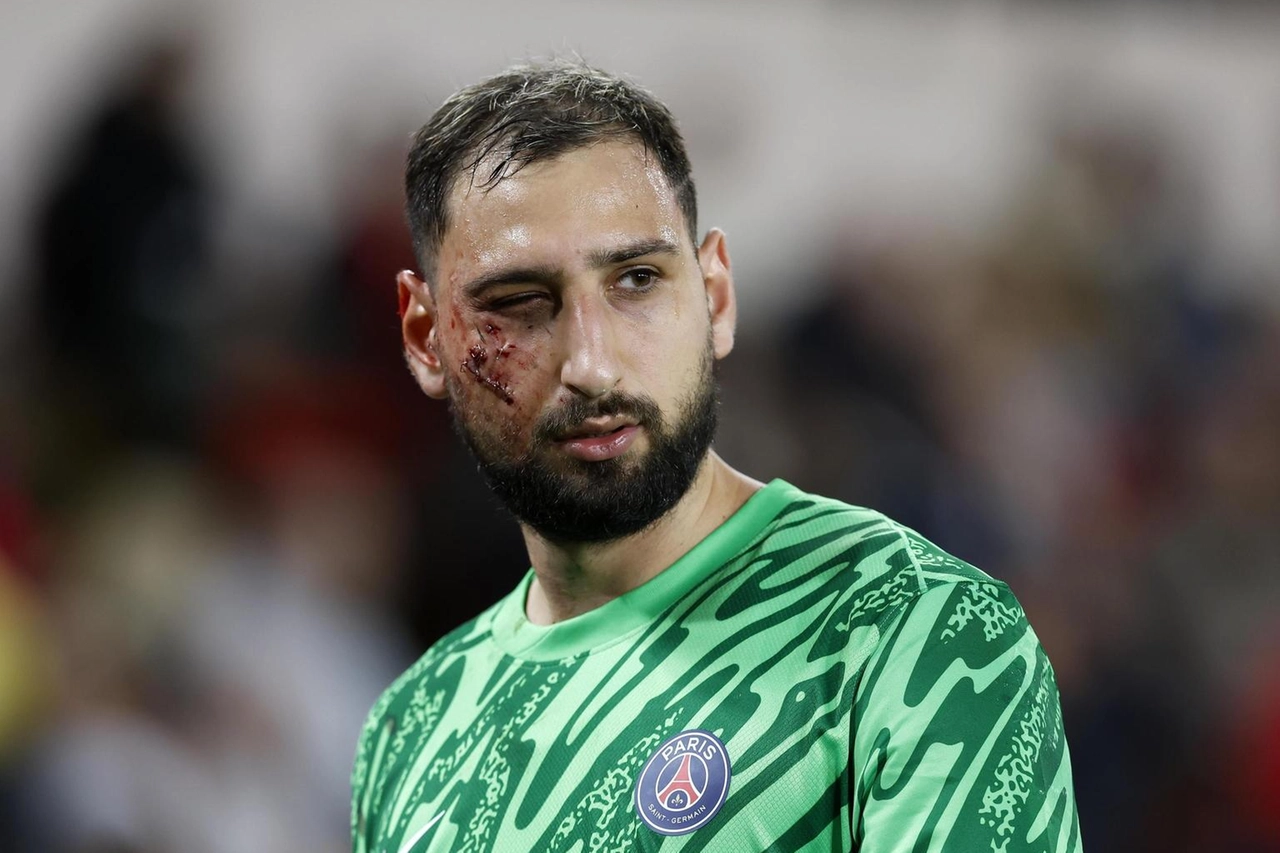 Gianluigi Donnarumma, punti metallici sulla guancia completamente aperta